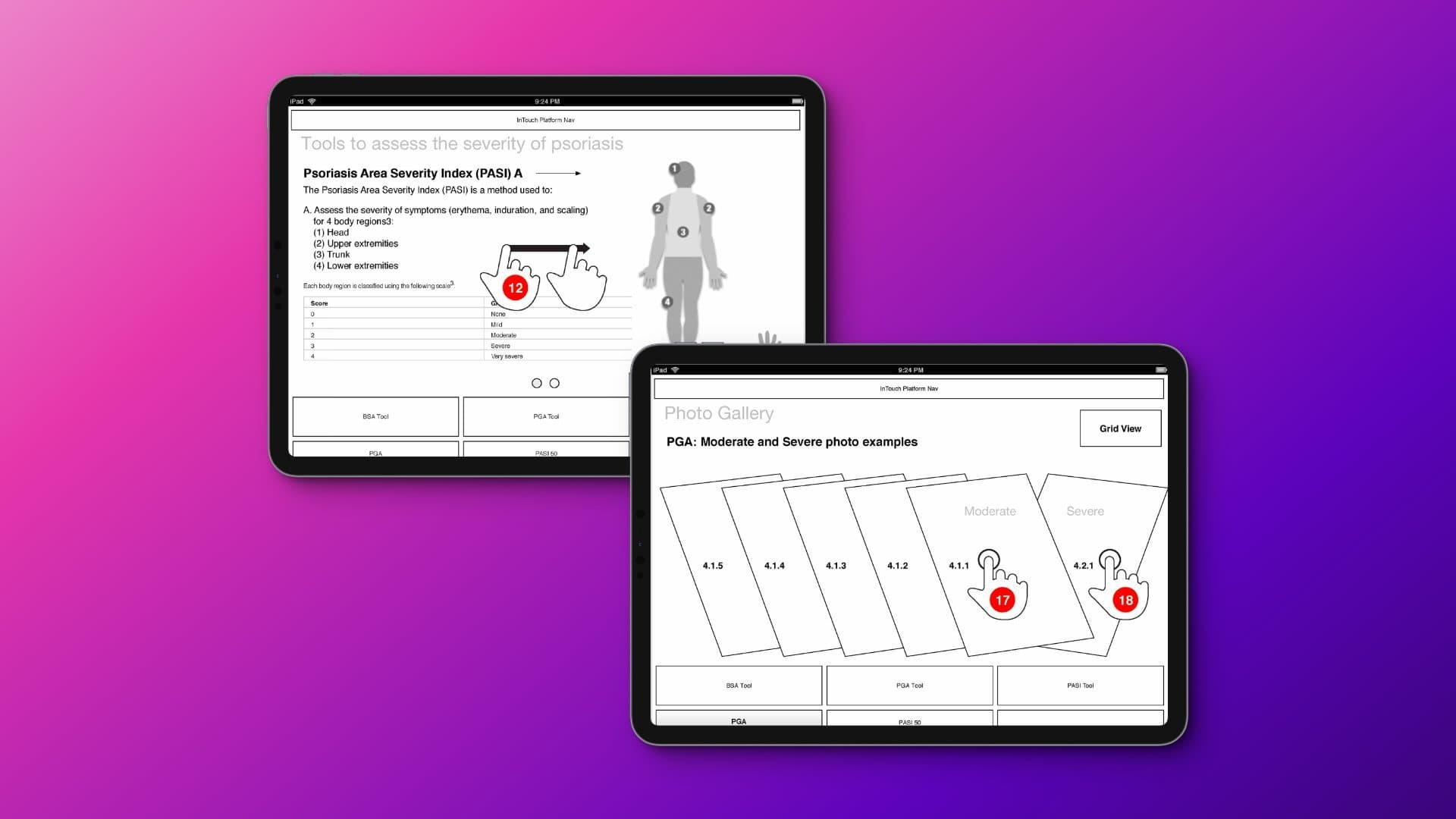 PASI/PGA psoriasis assessment tools — cross-therapeutic system extension